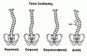 typoi-skoliosis