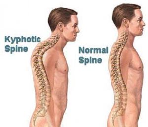 kyphosis