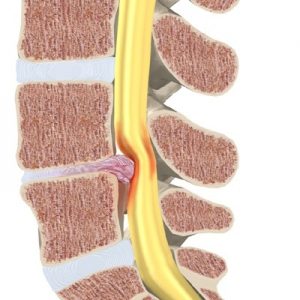 lumbar_herniation_b