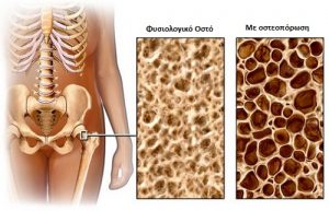 osteoporosis